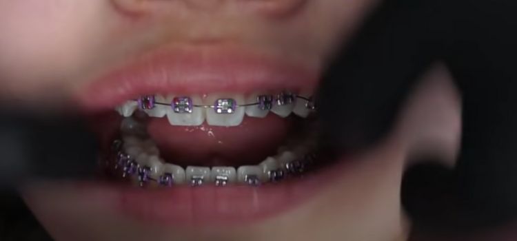 Can U Get Braces with Baby Teeth