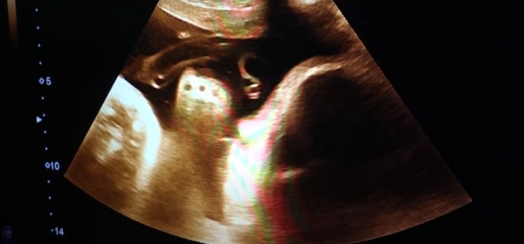 Can You See Baby Hair on Ultrasound