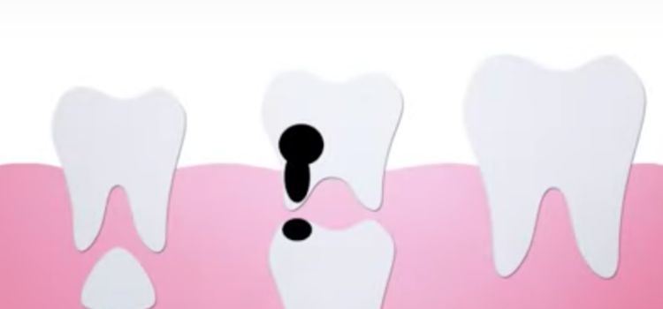 Do Baby Teeth Cavities Need to be Filled
