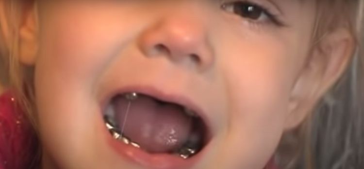 Do Baby Teeth with Crowns Fall Out on Their Own