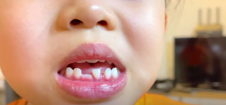 Pulling Baby Teeth vs Crowns